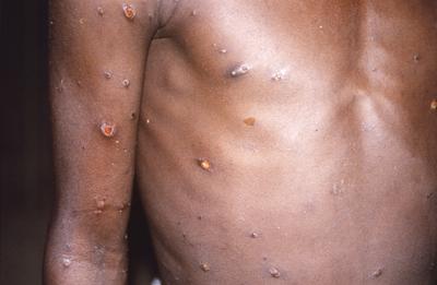 ARCHIVO - Esta imagen de 1997 facilitada por los Centros para el Control y la Prevención de Enfermedades de Estados Unidos (CDC por sus siglas en inglés) muestra a una persona con lesiones en la piel en lo que es un caso activo de viruela símica. (CDC via AP, File)