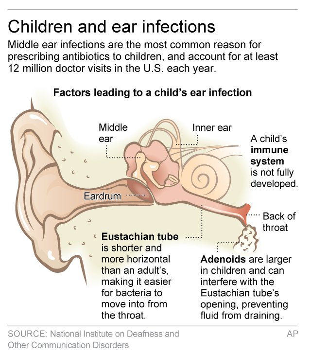 Researchers Creating Antibiotic Gel To Tackle Ear Infections