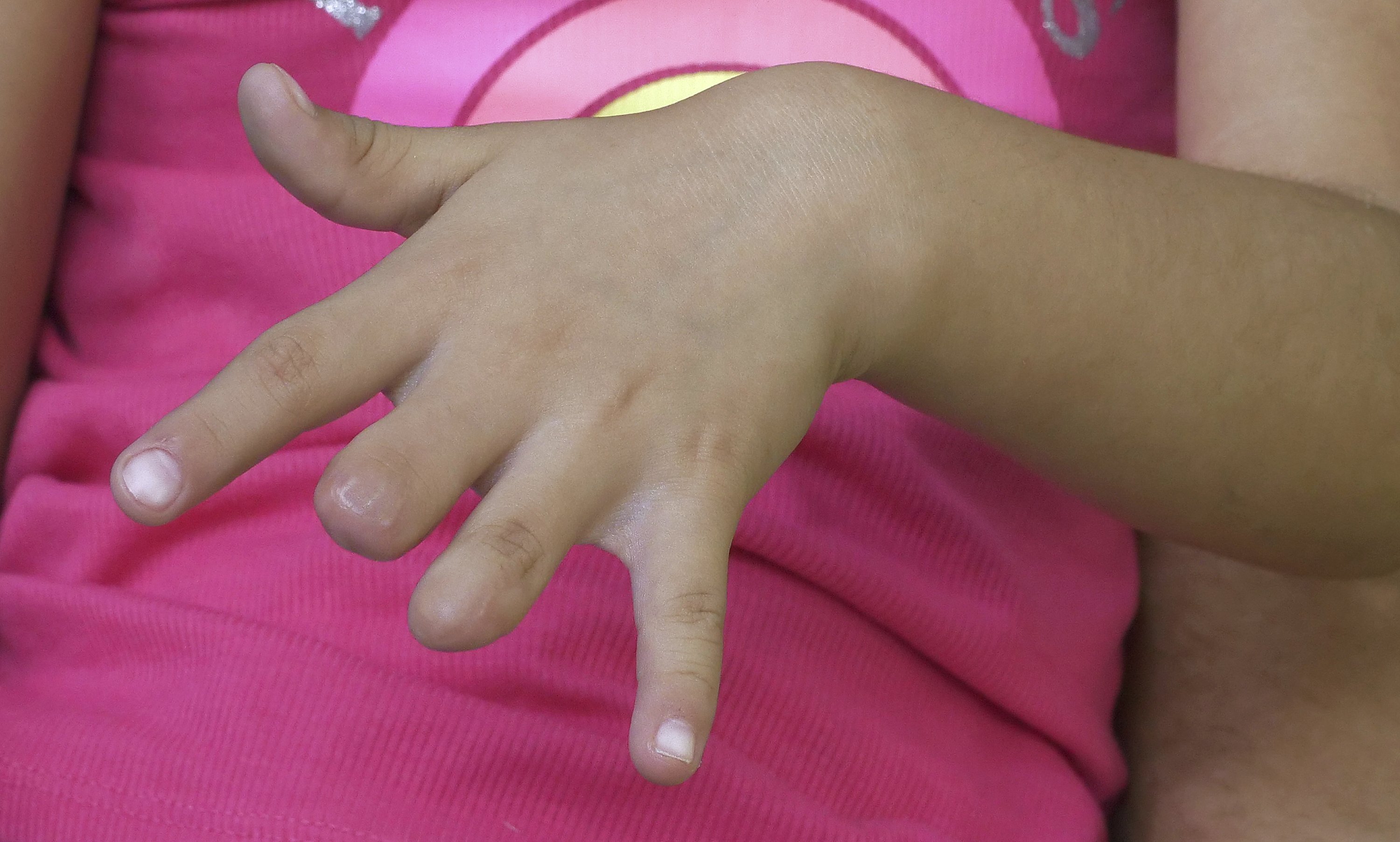 Dad Recalls Finding Girl With Fingers Severed By Escalator Ap News