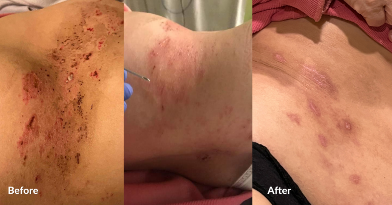 rash before and after