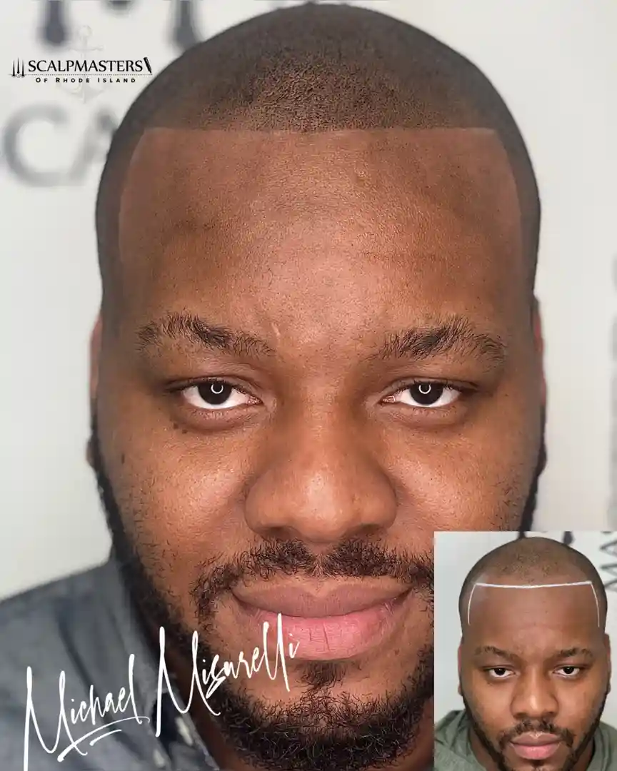 SMP artist carefully designing a hairline on a client in a clean, professional setting. - scalp micropigmentation clinic