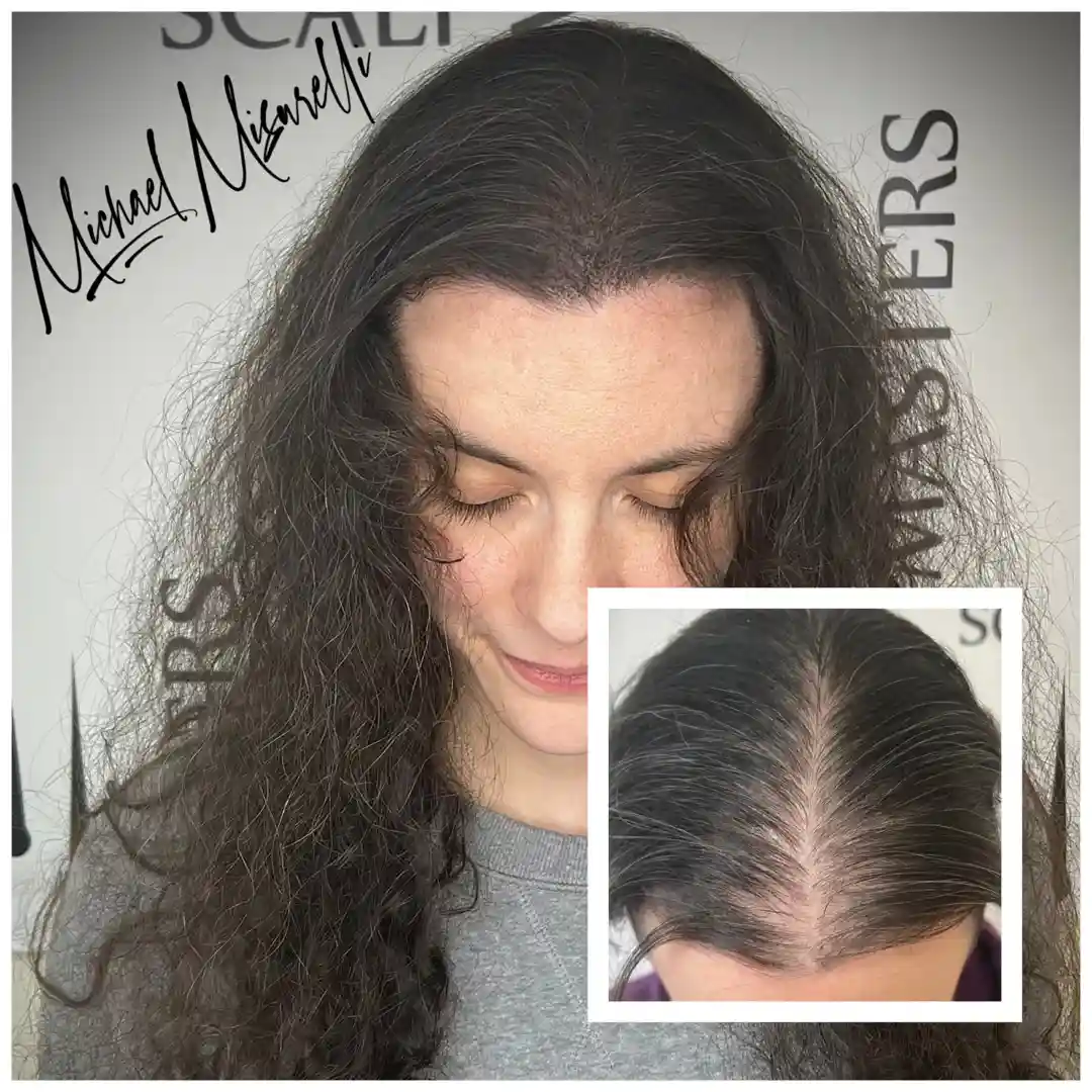 illustrating the difference between male M-shaped recession and female diffuse thinning - receding hairline solutions