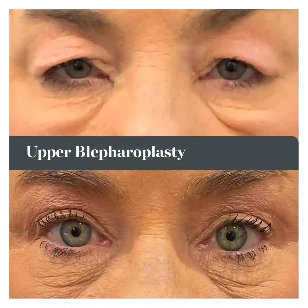 Difference between a drooping upper eyelid and a corrected one - eyebrow surgery