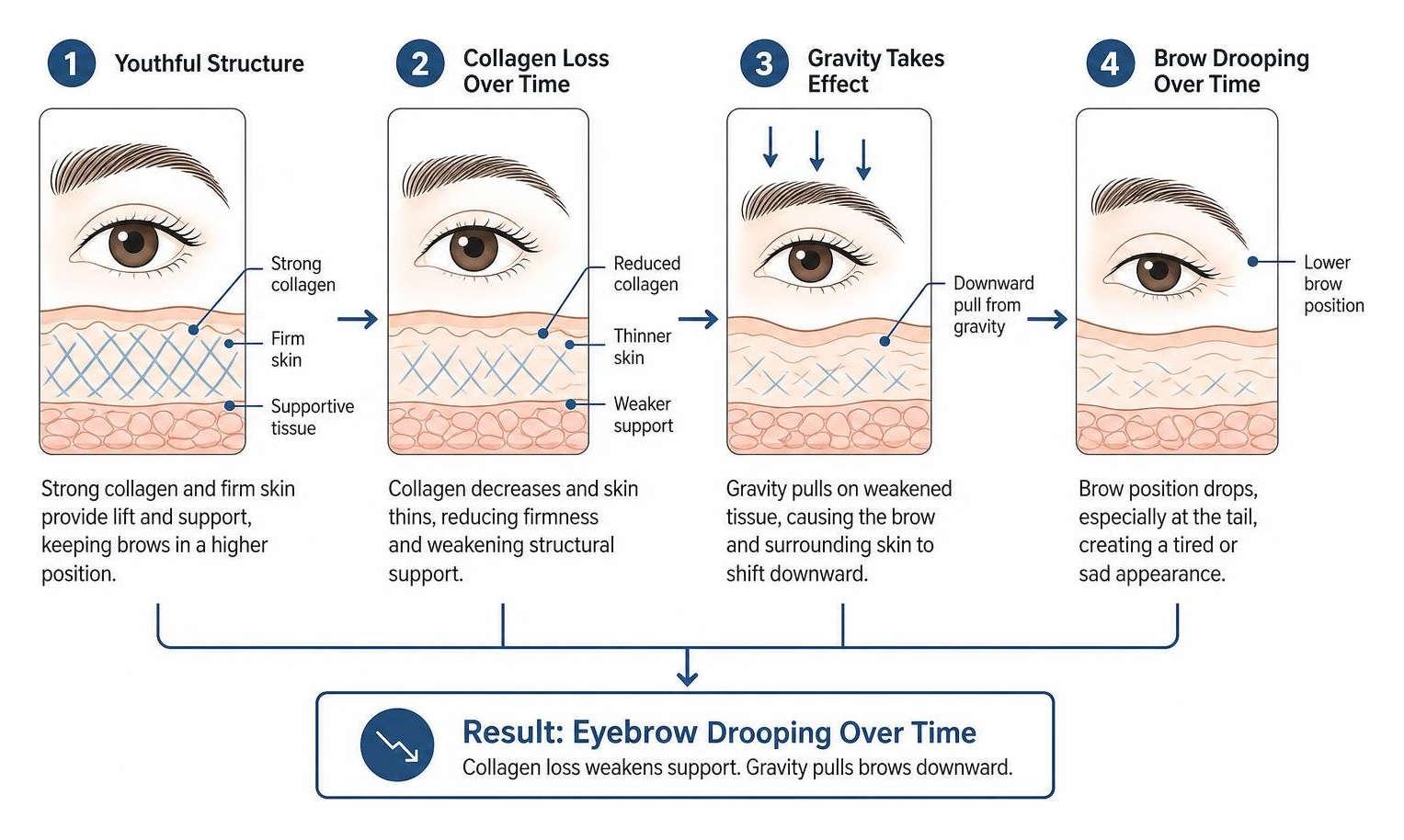 Diagram showing how collagen loss and gravity cause eyebrow drooping over time