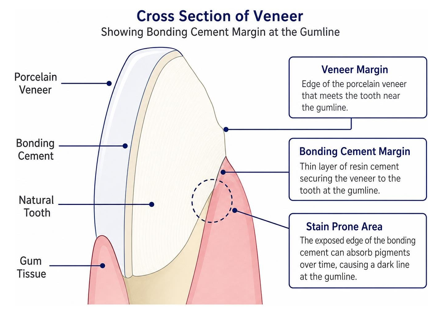 cross section of veneer showing bonding cement margin at the gumline