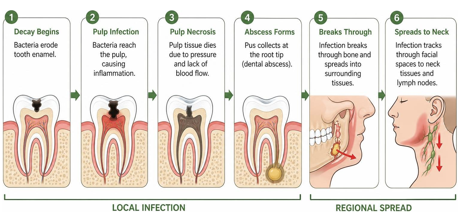 diagram of dental infection spread path from tooth to neck tissues diagram of dental infection spread path from tooth to neck tissues