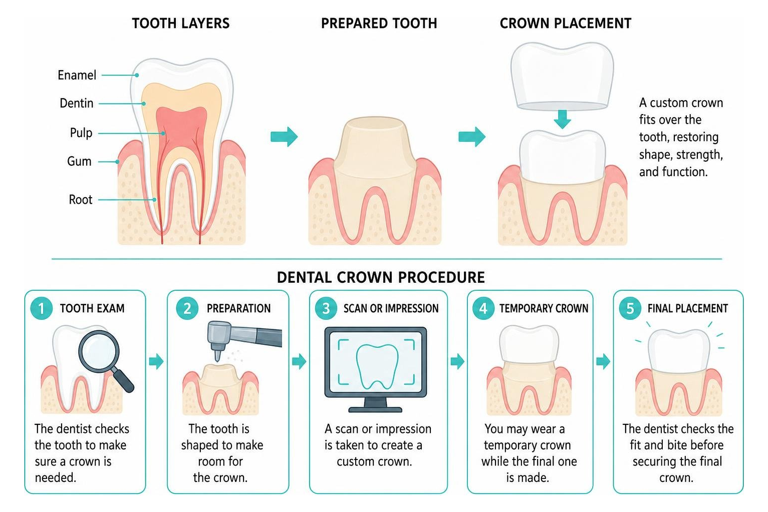 Diagram showing tooth layers and full-coverage dental crown placement over natural tooth structure