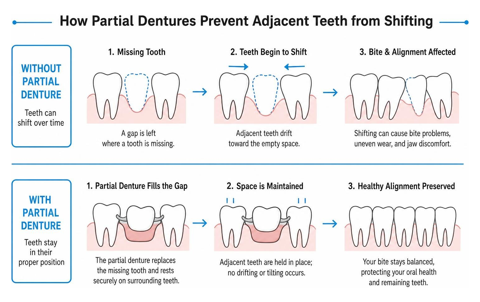 Diagram of how partial dentures prevent adjacent teeth from shifting