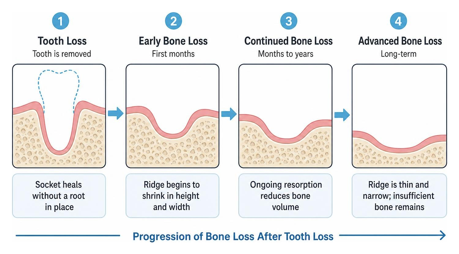 Diagram showing progression of bone loss after tooth loss Diagram showing progression of bone loss after tooth loss
