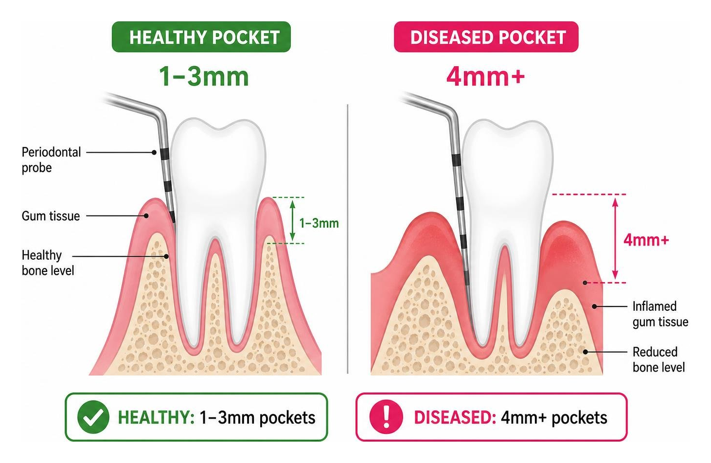 Diagram of gum pocket depths showing healthy 1-3mm pockets vs diseased 4mm plus pockets