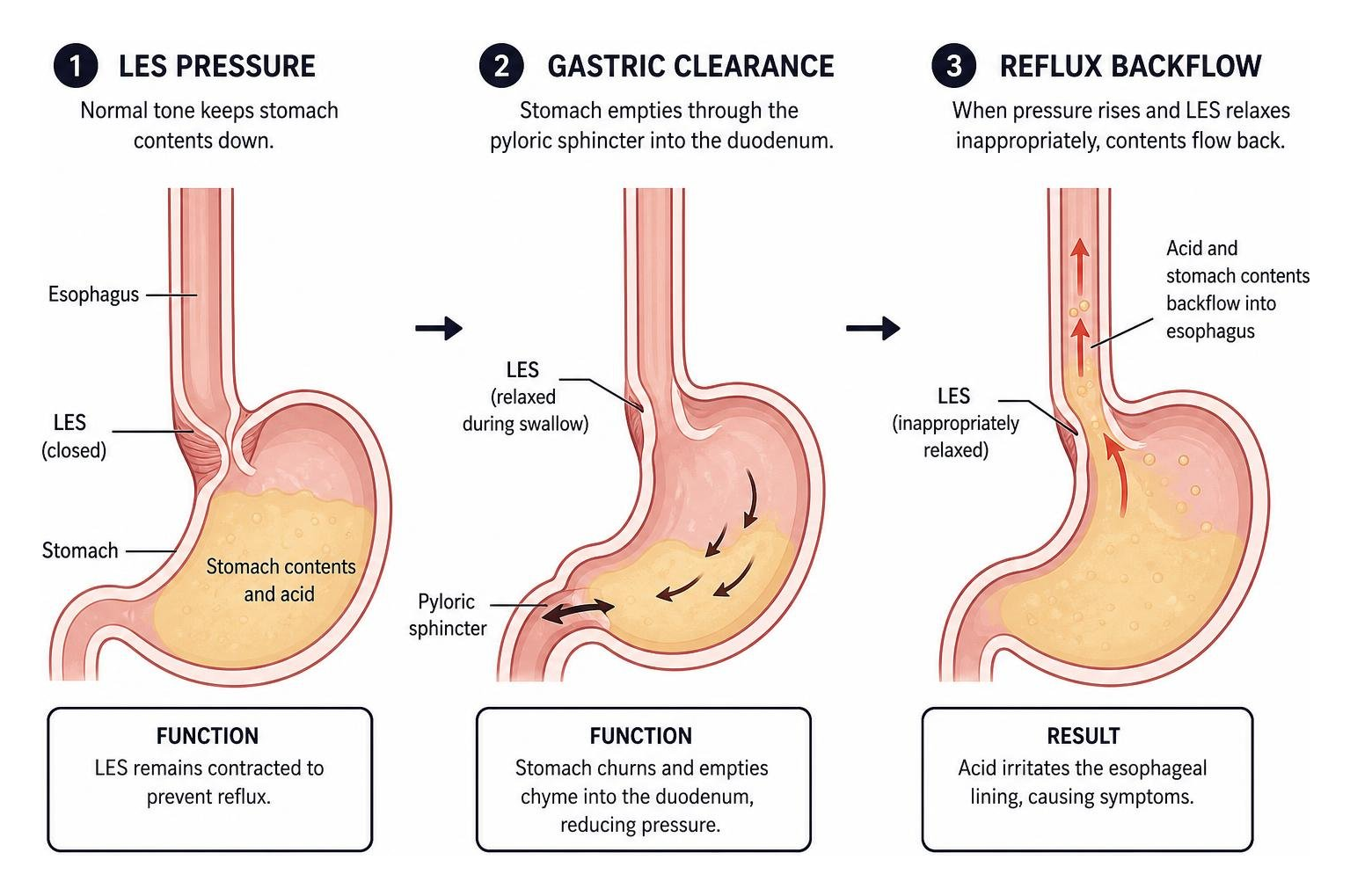Digestive mechanics of LES pressure, gastric clearance, and reflux backflow