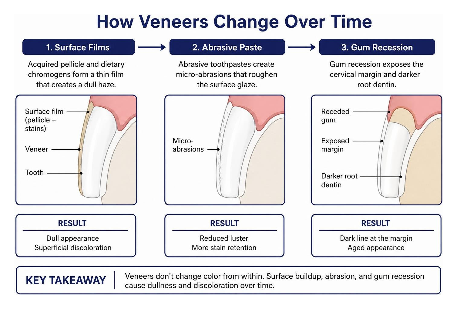 How veneers change over time due to surface films, abrasive paste, and gum recession