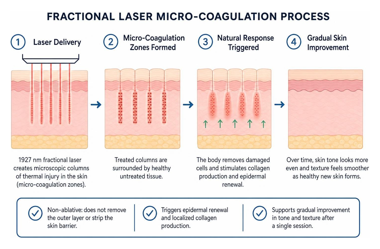 fractional laser micro-coagulation process diagram