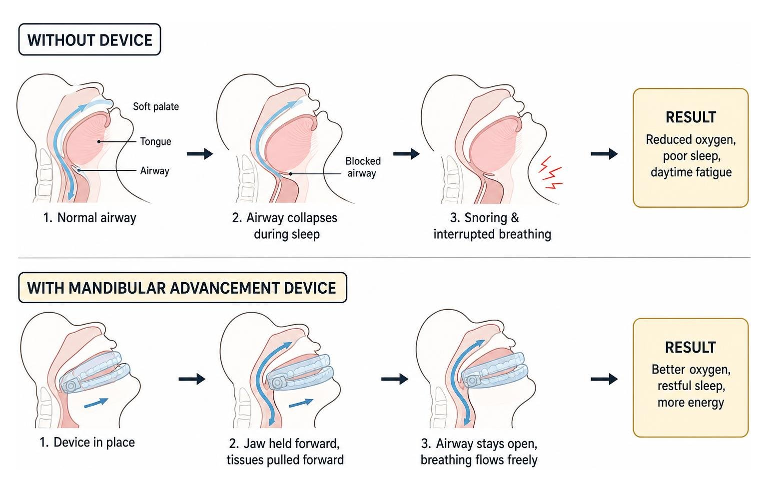 how a mandibular advancement device keeps the airway open diagram
