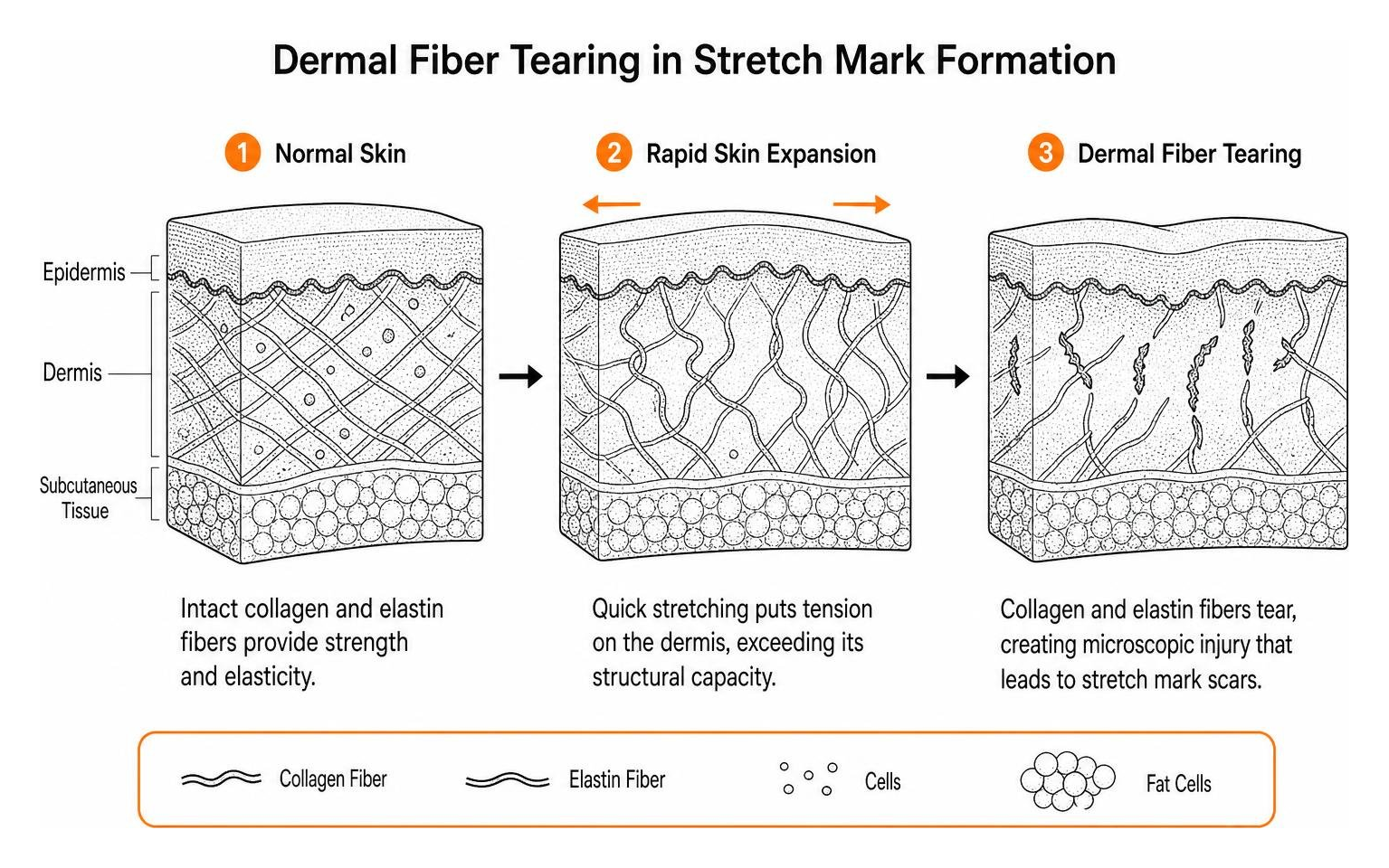 cross section of skin layers showing dermal fiber tearing