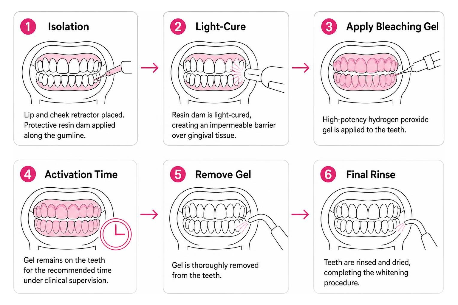 Step-by-step chairside bleaching process from isolation to final rinse Step-by-step chairside bleaching process from isolation to final rinse