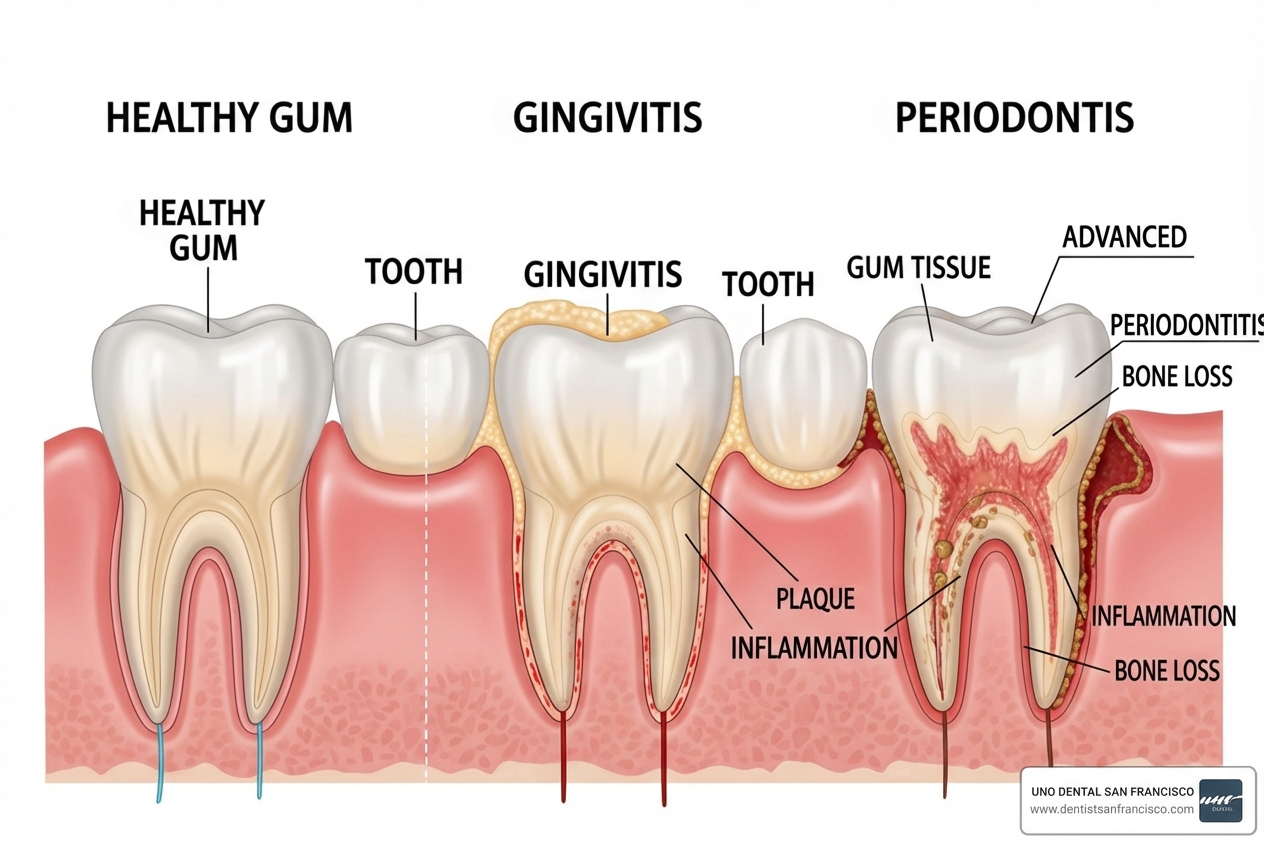 illustration showing healthy gums vs. gums with gingivitis and periodontitis - bad breath clinic san francisco illustration showing healthy gums vs. gums with gingivitis and periodontitis - bad breath clinic san francisco
