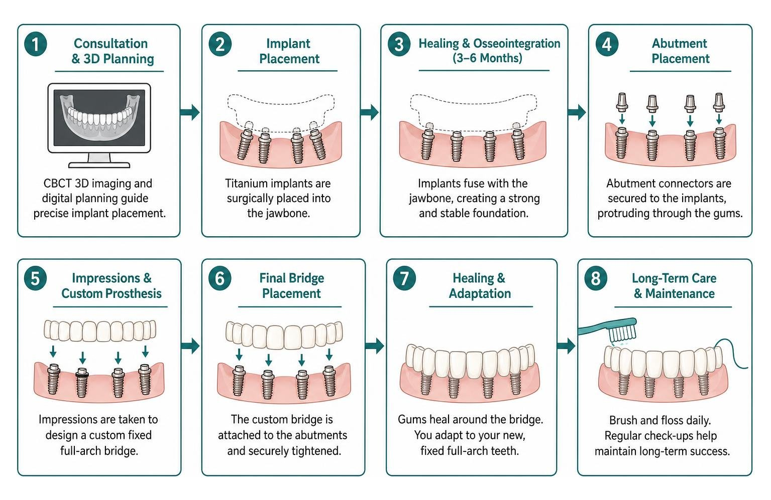 Step-by-step process of full arch dental implant placement and healing