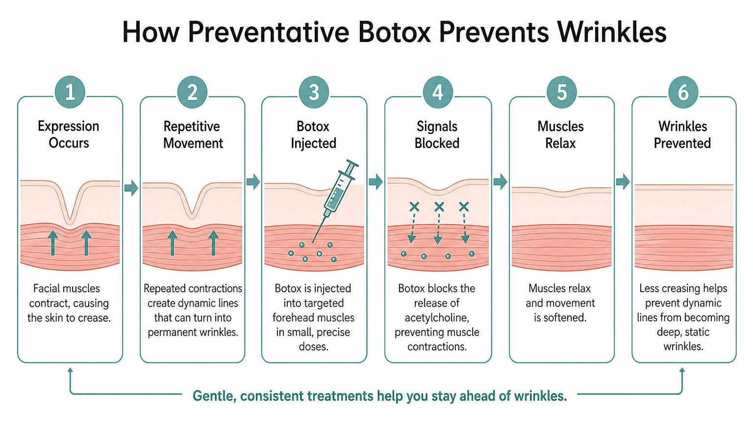 Step-by-step process of how preventative Botox prevents wrinkles