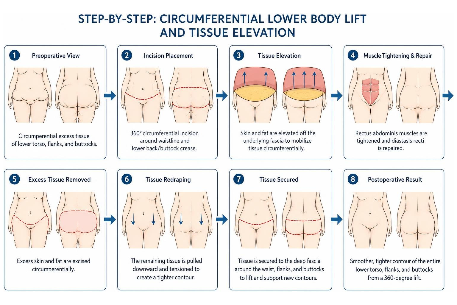 Step-by-step anatomical sequence of a circumferential lower body lift and tissue elevation