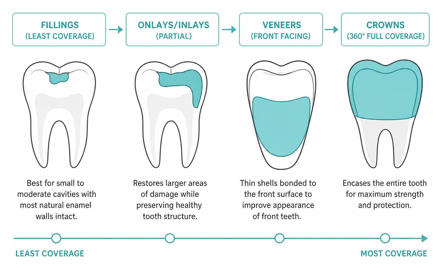 Coverage comparison between fillings, onlays, veneers, and full-coverage crowns Coverage comparison between fillings, onlays, veneers, and full-coverage crowns
