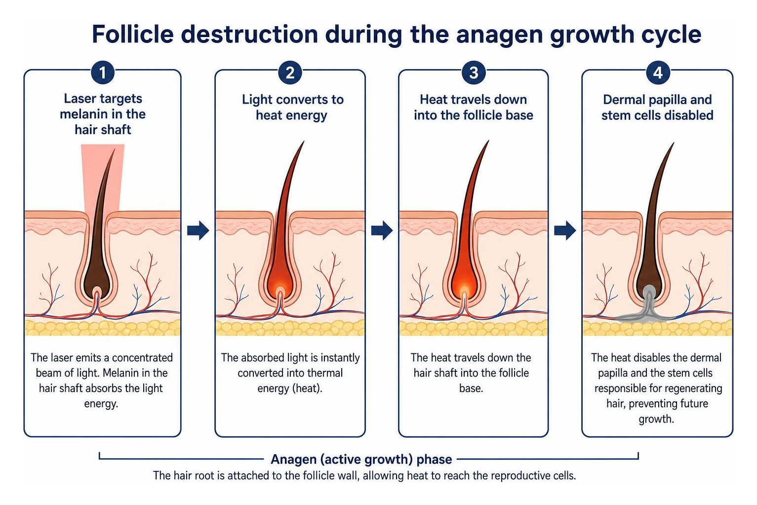 Follicle destruction during the anagen growth cycle Follicle destruction during the anagen growth cycle