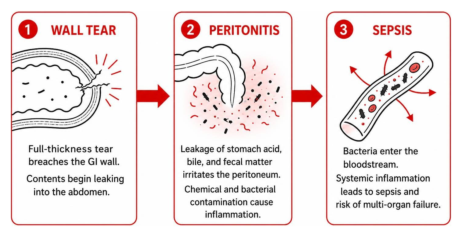 Progression of gastrointestinal rupture from wall tear to peritonitis and sepsis Progression of gastrointestinal rupture from wall tear to peritonitis and sepsis