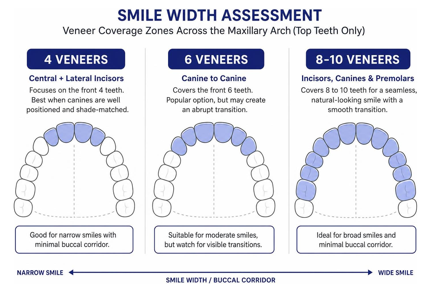 Diagram showing smile width assessment: 4 vs 6 vs 8-10 veneer coverage zones across the maxillary arch