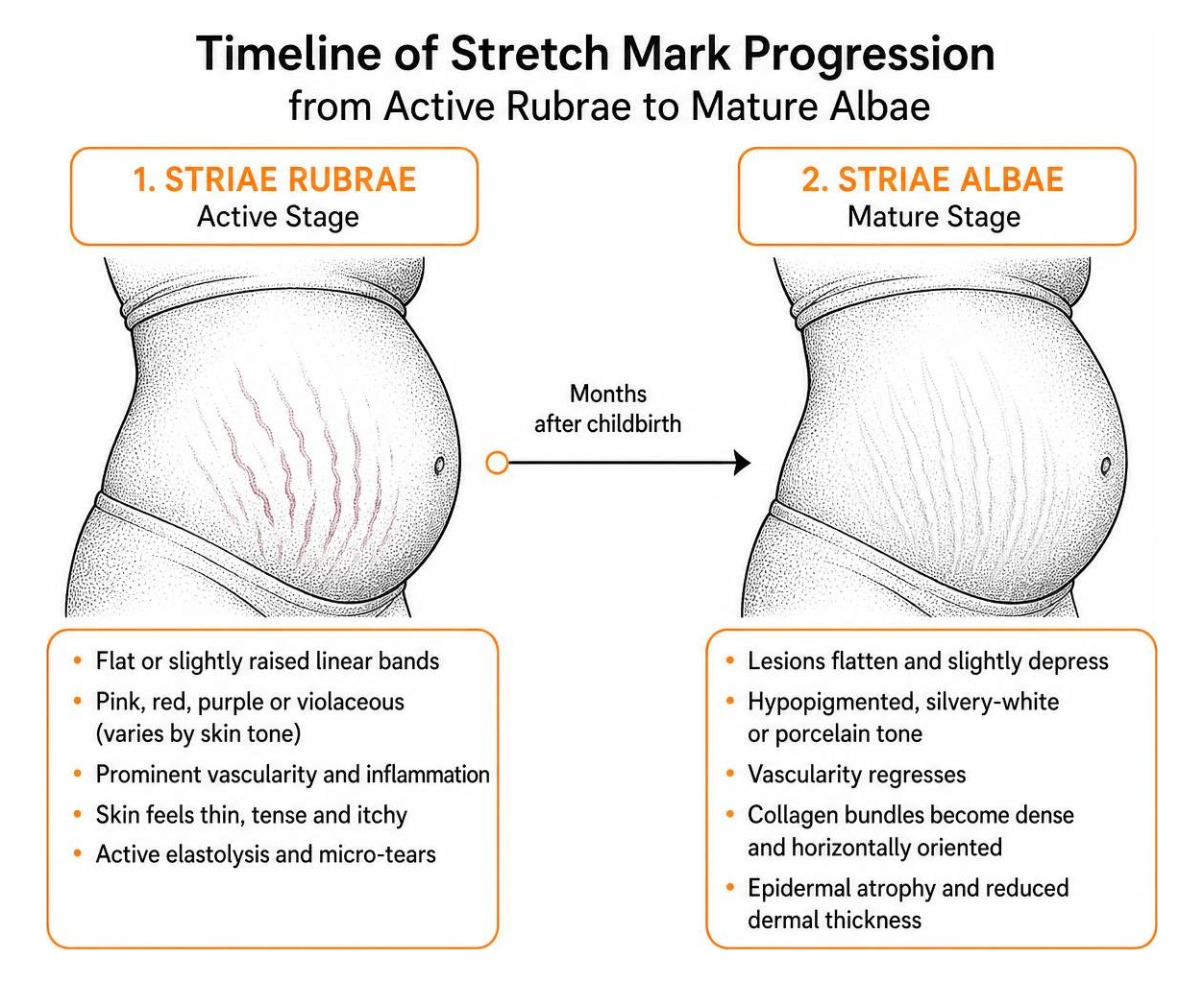 timeline of stretch mark progression from active rubrae to mature albae timeline of stretch mark progression from active rubrae to mature albae