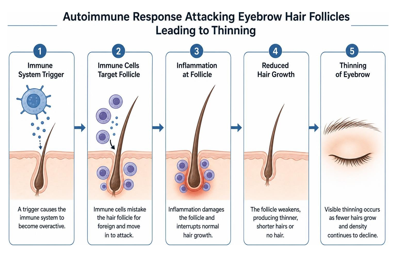 Diagram showing autoimmune response attacking eyebrow hair follicles leading to thinning