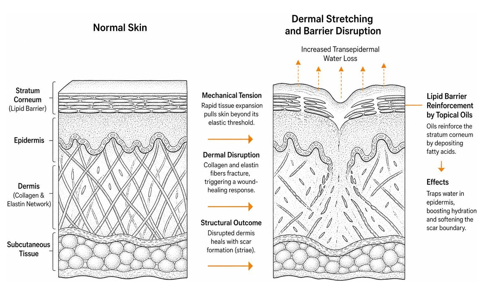 cross section of skin layers showing dermal stretching and lipid barrier
