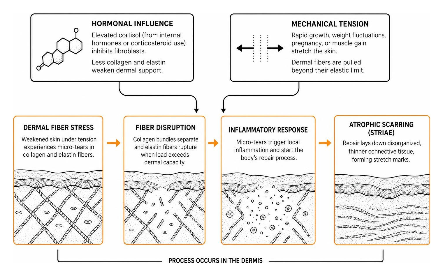 diagram of hormonal influence and mechanical tension leading to striae diagram of hormonal influence and mechanical tension leading to striae
