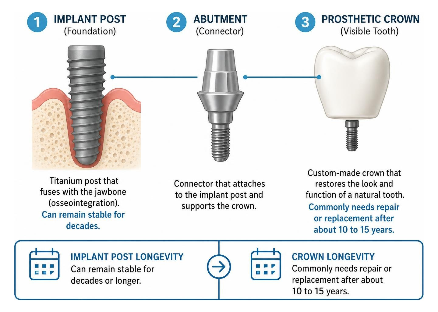 Anatomy of dental implant post abutment and prosthetic crown Anatomy of dental implant post abutment and prosthetic crown