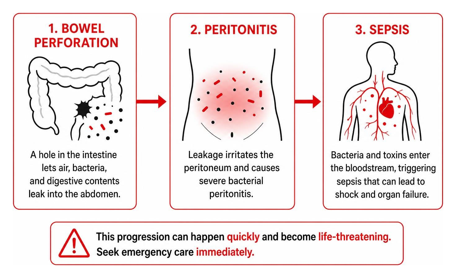 Progression of bowel perforation to peritonitis and sepsis Progression of bowel perforation to peritonitis and sepsis