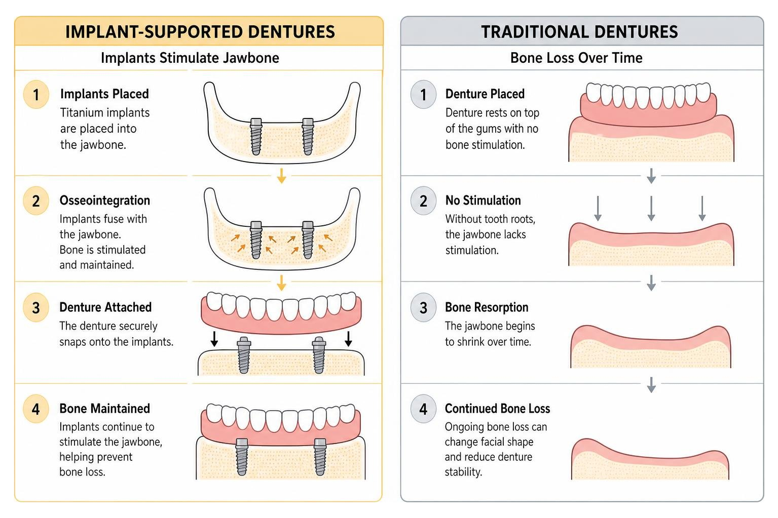 Diagram showing how implants stimulate jawbone compared to bone loss under traditional dentures Diagram showing how implants stimulate jawbone compared to bone loss under traditional dentures