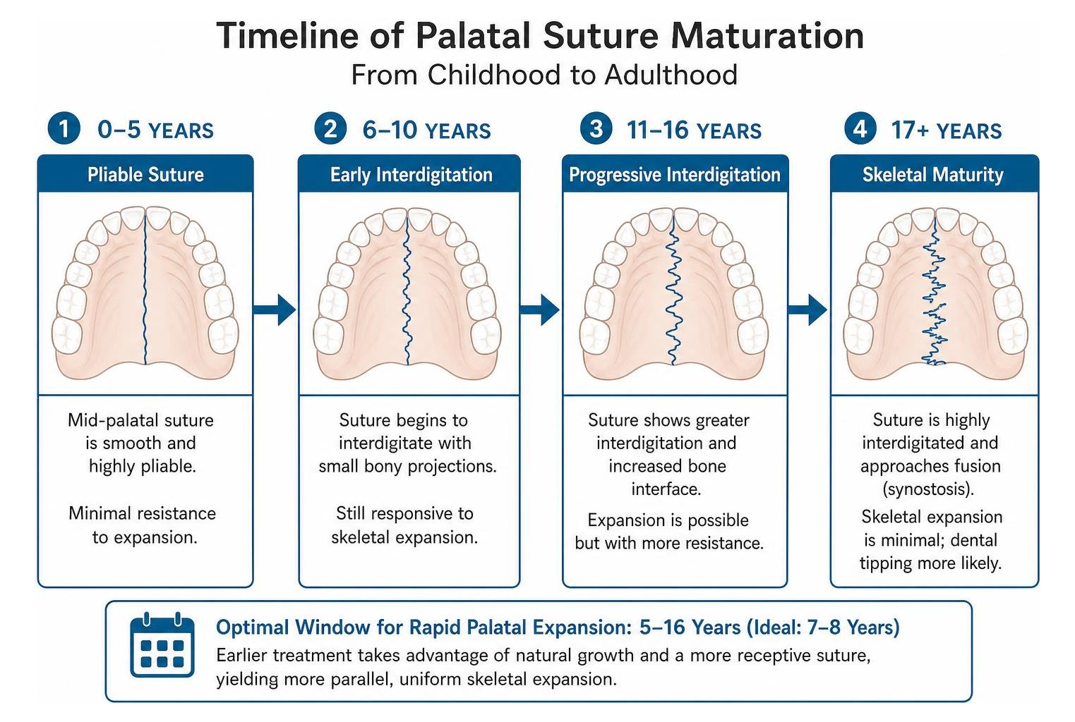 Timeline of palatal suture maturation from childhood to adulthood