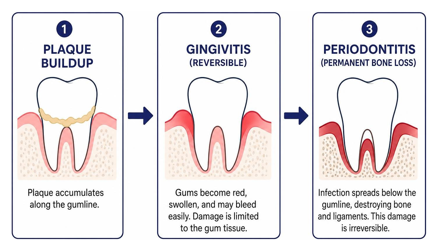 Progression from plaque buildup to irreversible periodontitis