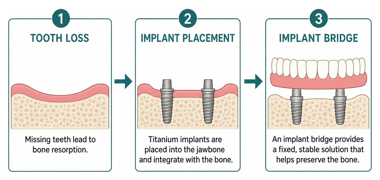 Progression from tooth loss to bone preservation with an implant bridge Progression from tooth loss to bone preservation with an implant bridge