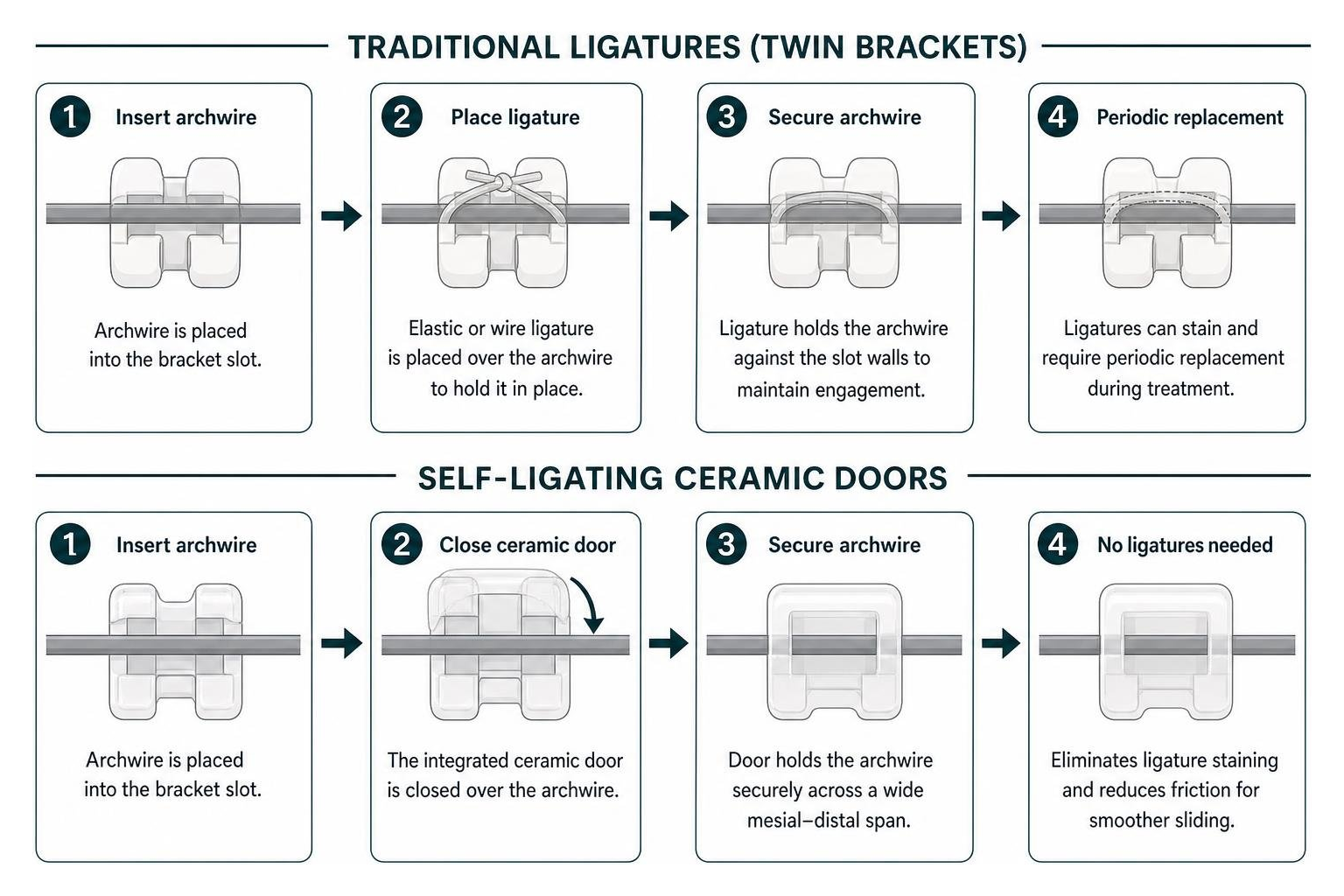 Step-by-step mechanism of traditional ligatures versus self-ligating ceramic doors