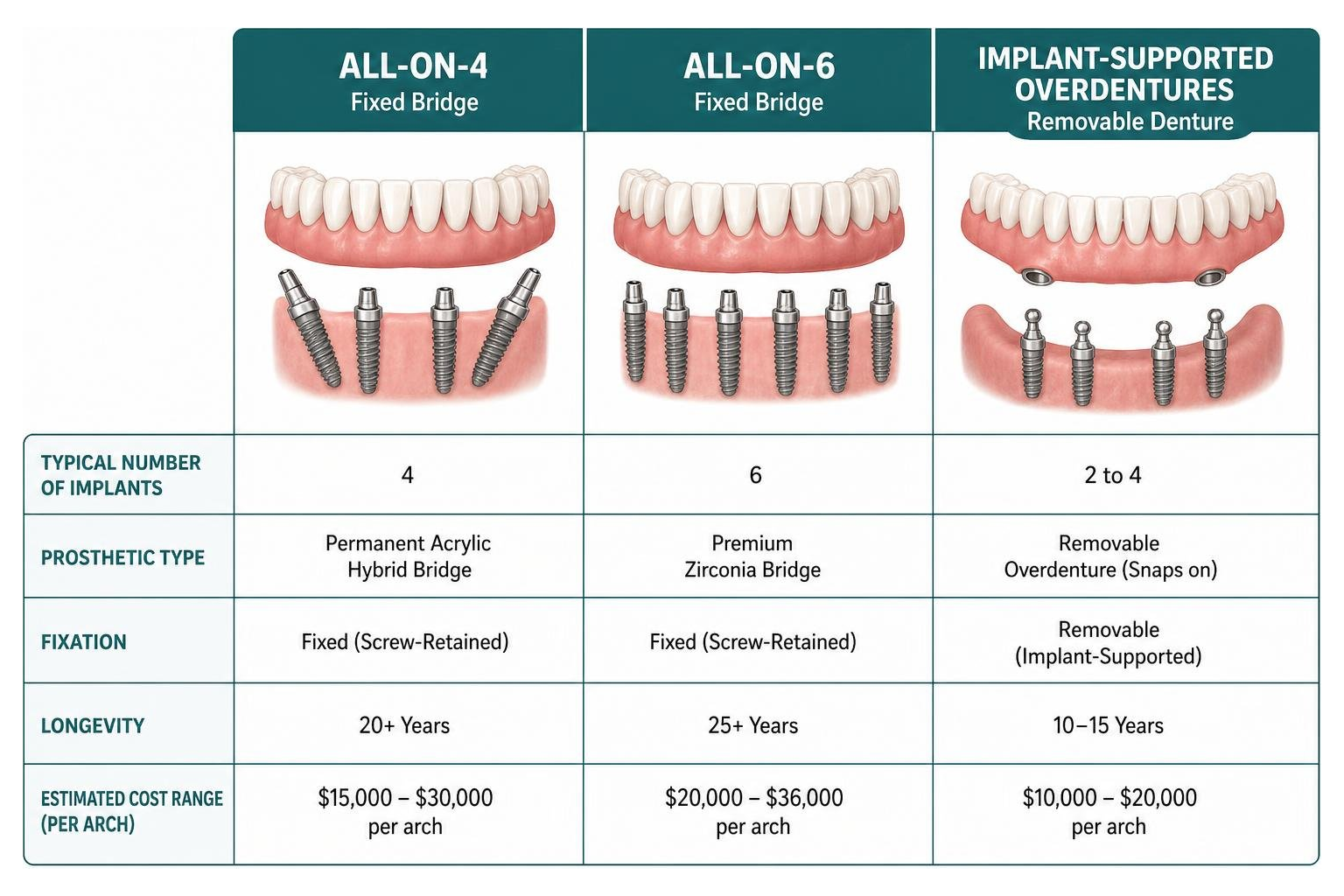 diagram of full mouth dental implant options comparing All-on-4, All-on-6, and overdentures diagram of full mouth dental implant options comparing All-on-4, All-on-6, and overdentures