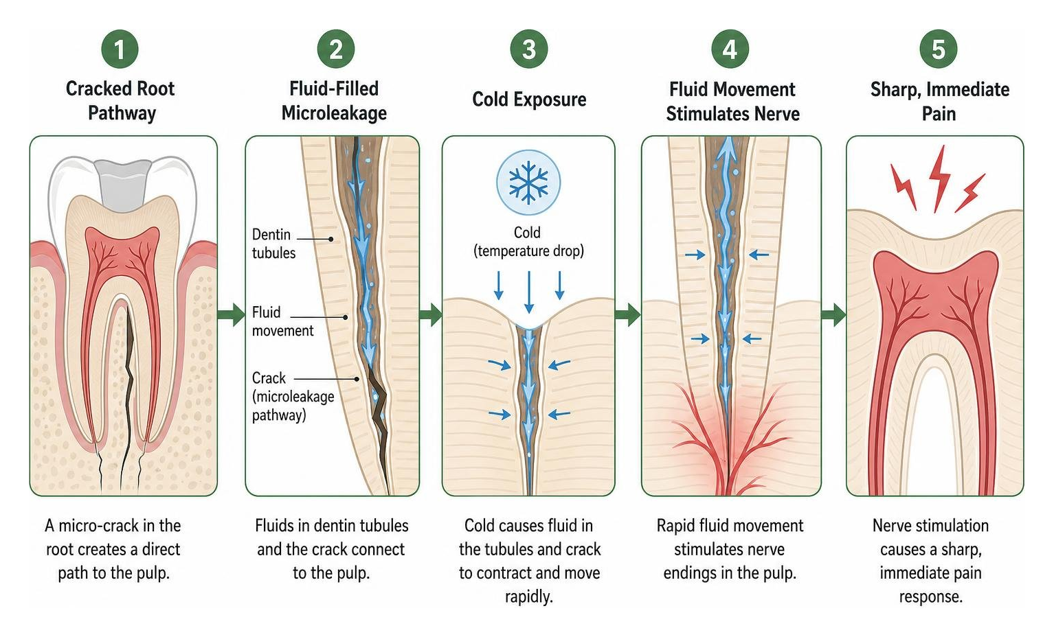Diagram of fluid movement and microleakage in a cracked tooth root