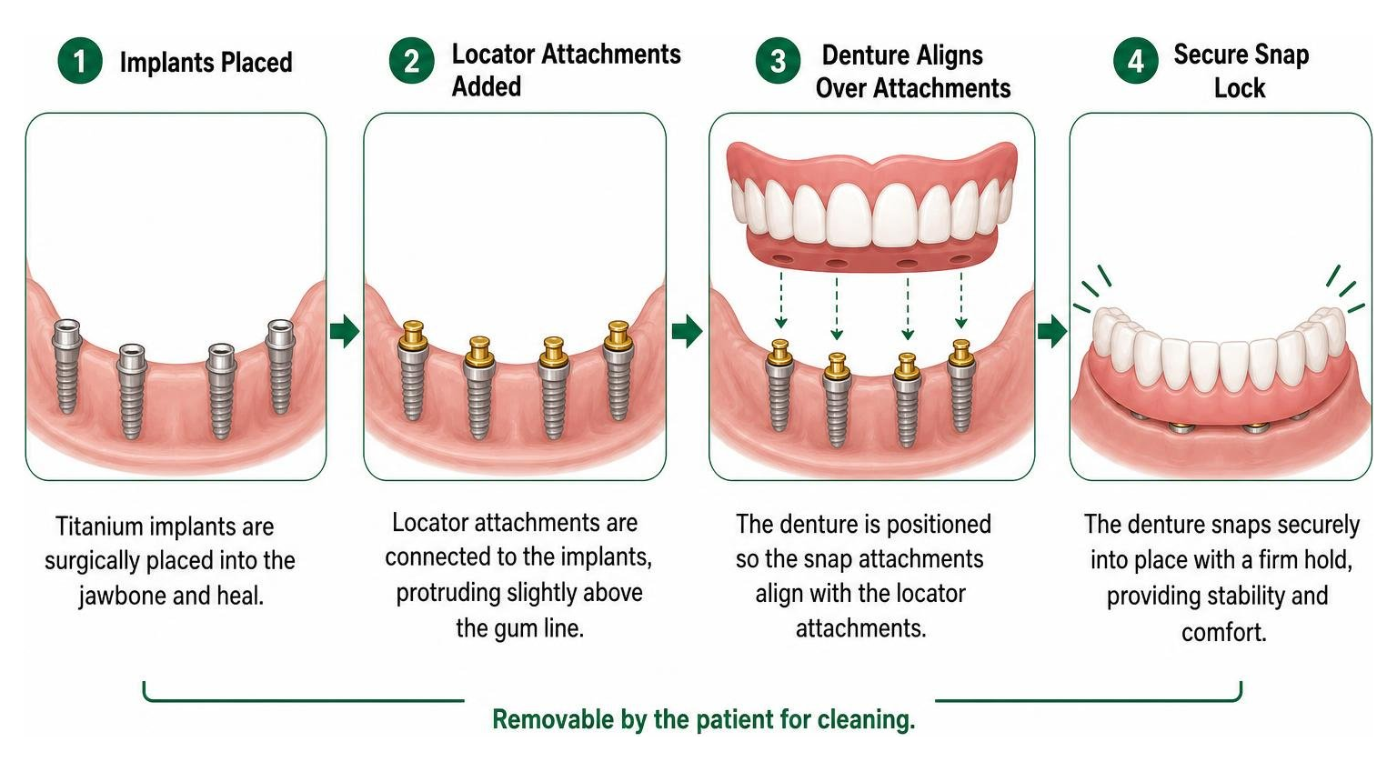 How snap-on dentures attach securely to jawbone implants