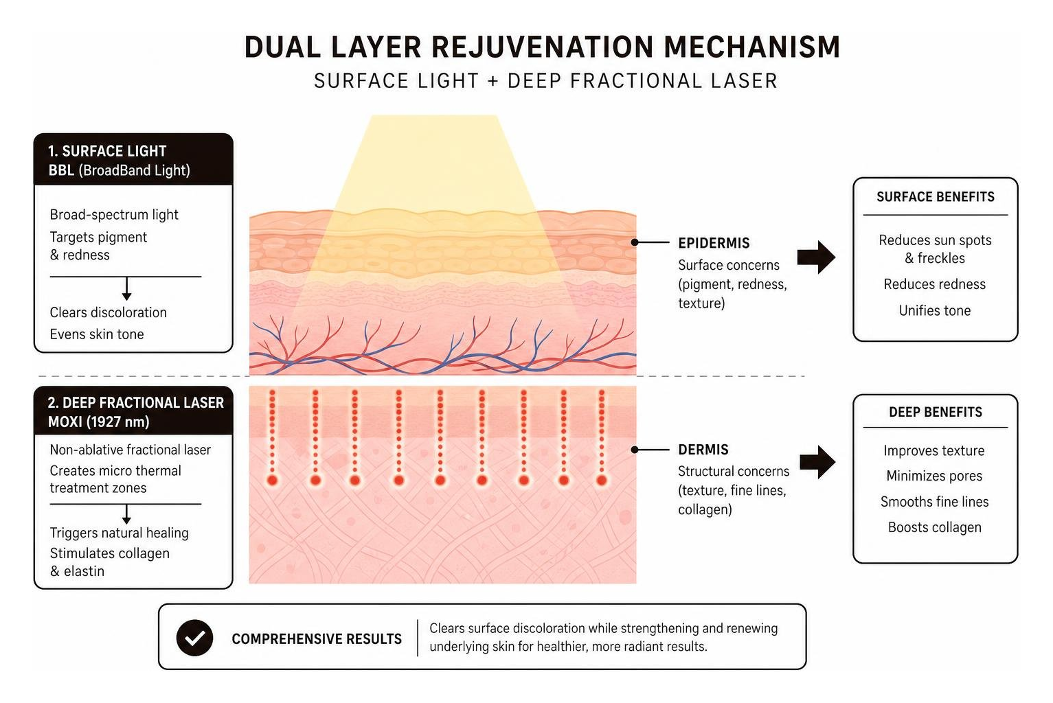 Dual layer rejuvenation mechanism showing surface light and deep fractional laser Dual layer rejuvenation mechanism showing surface light and deep fractional laser