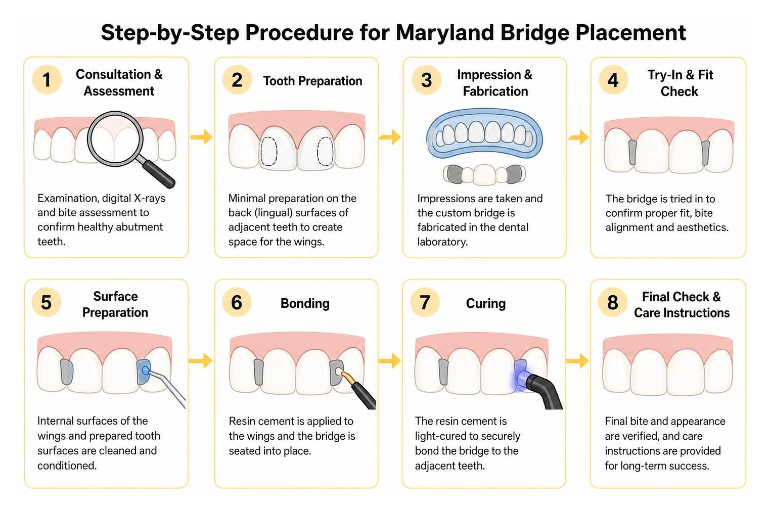 Step-by-step procedure for Maryland bridge placement Step-by-step procedure for Maryland bridge placement