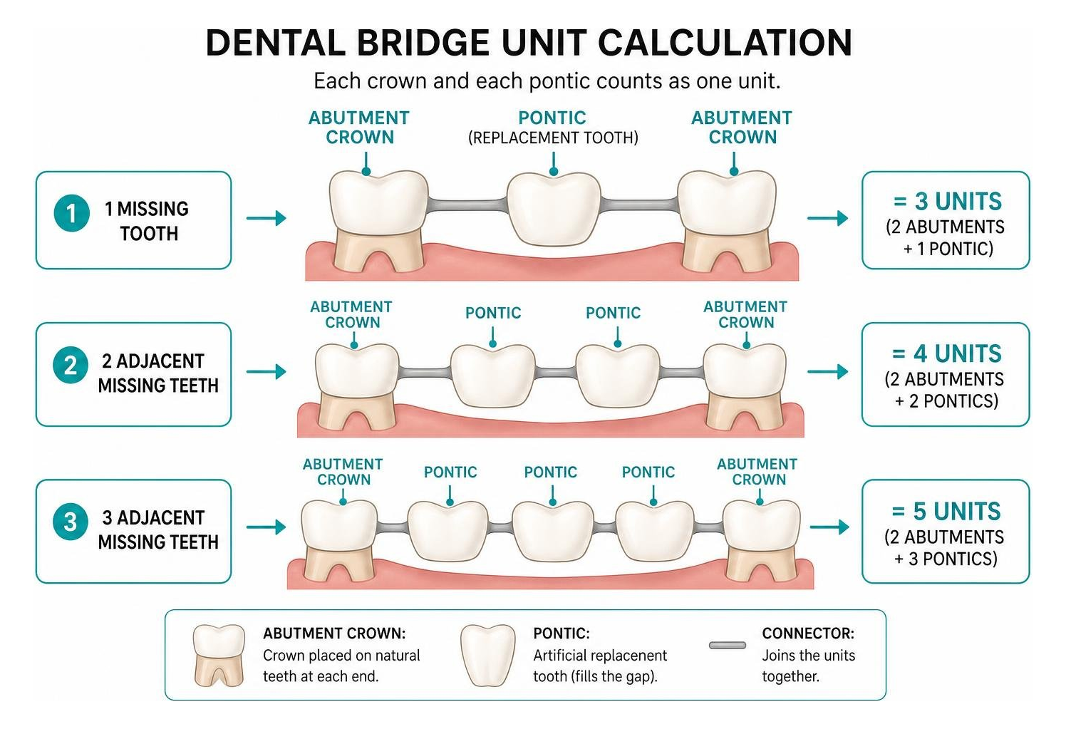 Diagram of dental bridge unit calculation showing abutments and pontics