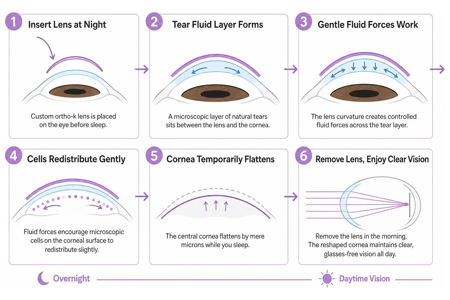 step by step overnight corneal reshaping process from insertion to clear daytime vision