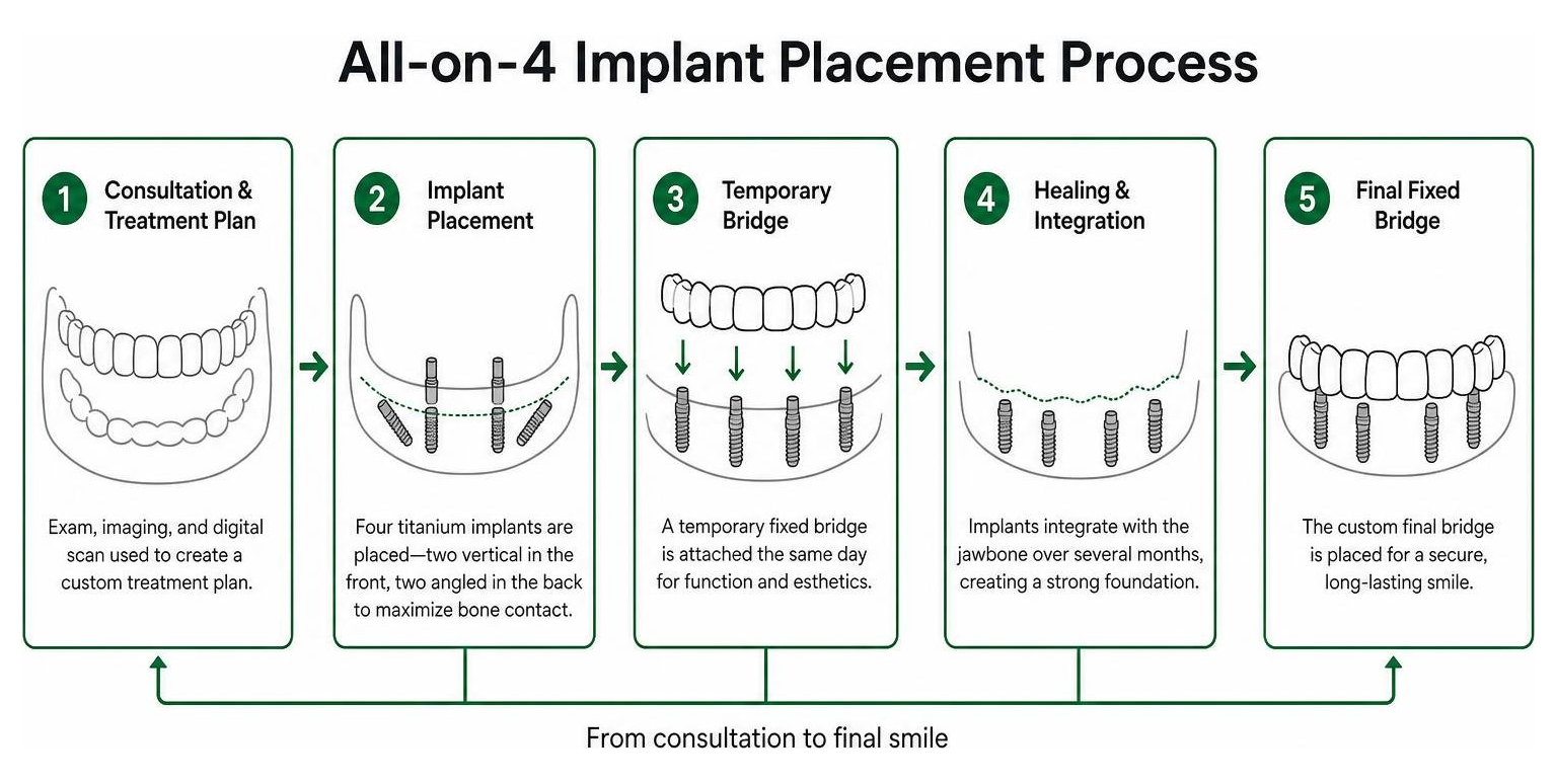 All-on-4 implant placement process diagram