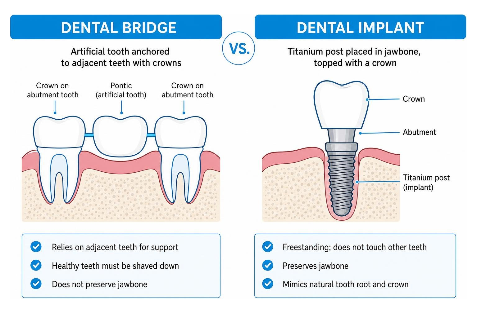 structural comparison of a dental bridge versus a dental implant