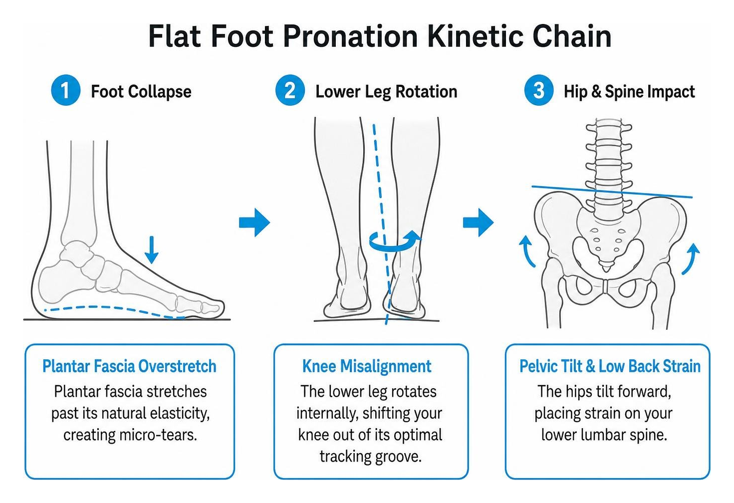 flat foot pronation kinetic chain biomechanics flat foot pronation kinetic chain biomechanics
