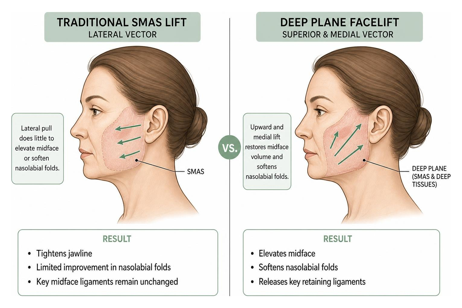 diagram comparing deep plane facelift vector to traditional SMAS lift vector diagram comparing deep plane facelift vector to traditional SMAS lift vector